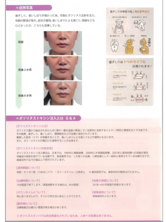 ボトックス治療　導入