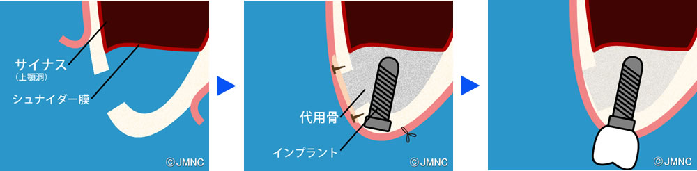 サイナスリフト