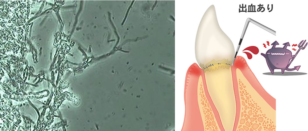 歯周病