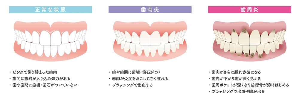 歯周病の進行状態